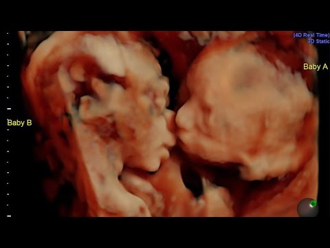 شاهد توأم يُقبِّلان بعضهما داخل رحم أمهما