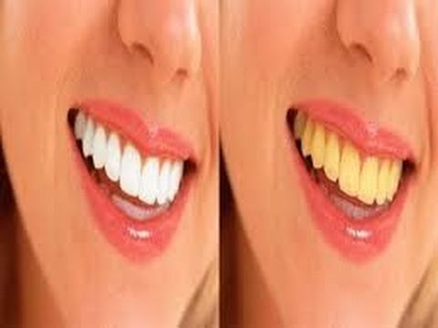أسرع الطرق المنزلية لتبييض الأسنان