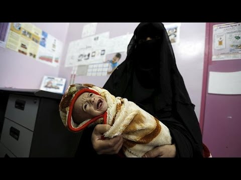 أطفال اليمن يعانون سوء التغذية والمجاعة تهدد معظم السكان