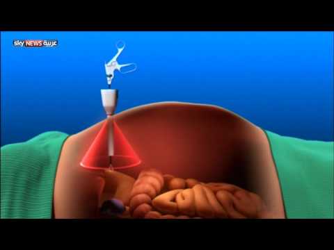 بالفيديو تقنية حديثة لإجراء العمليات الجراحية في المغناطيس